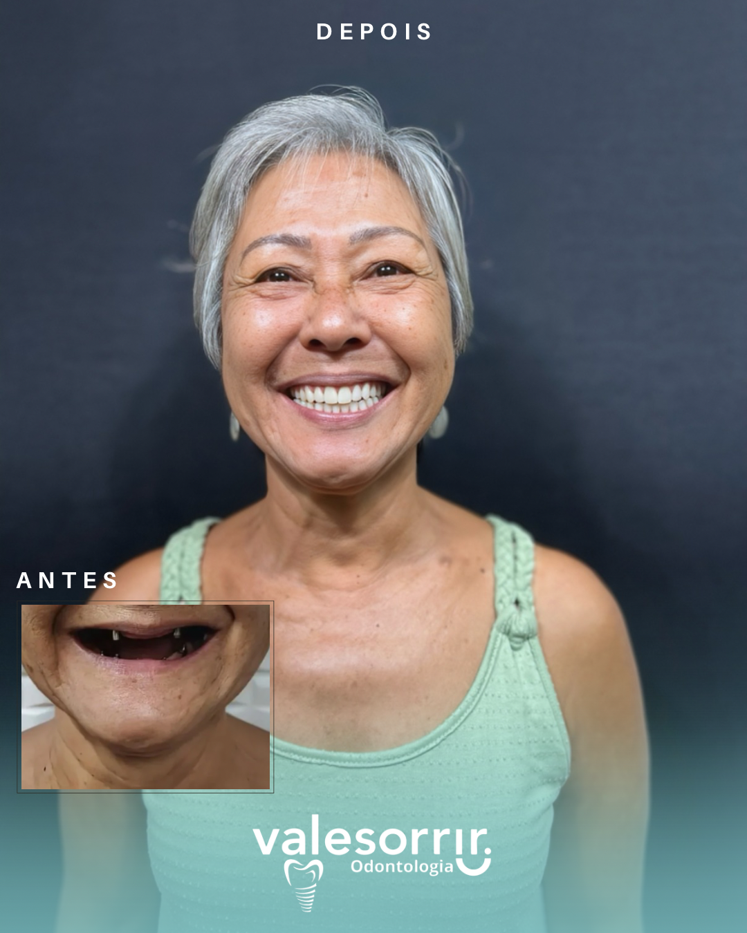 Antes e depois - Edna