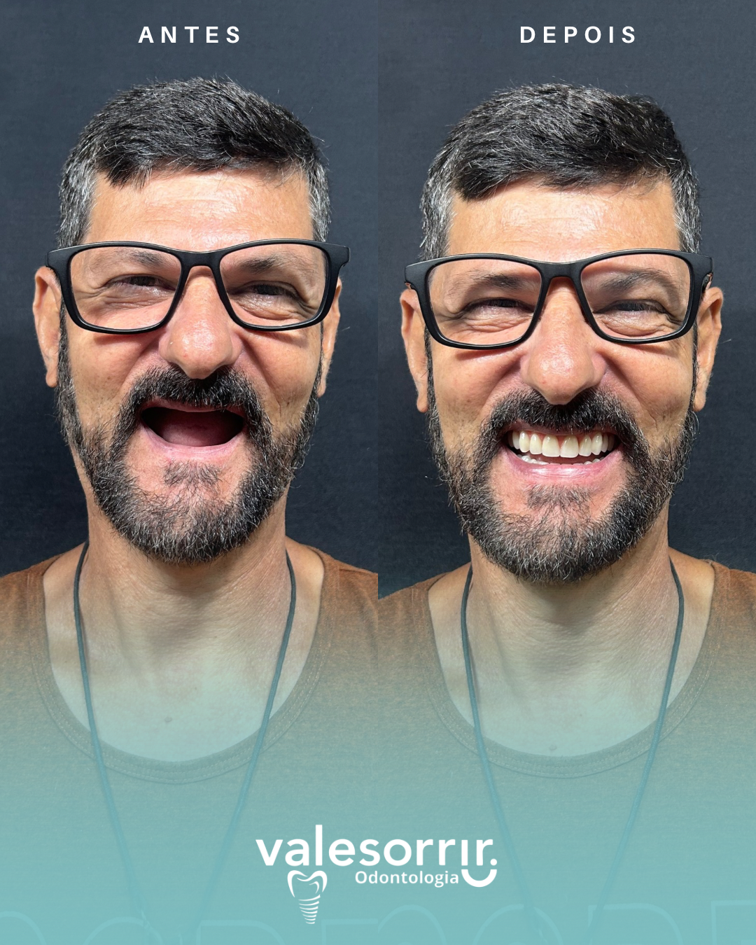 Antes e depois - Flávio - 1