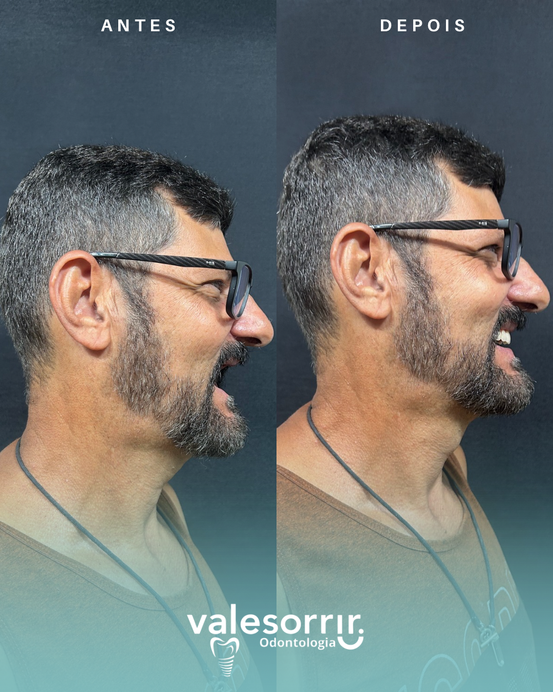 Antes e depois - Flávio - 2