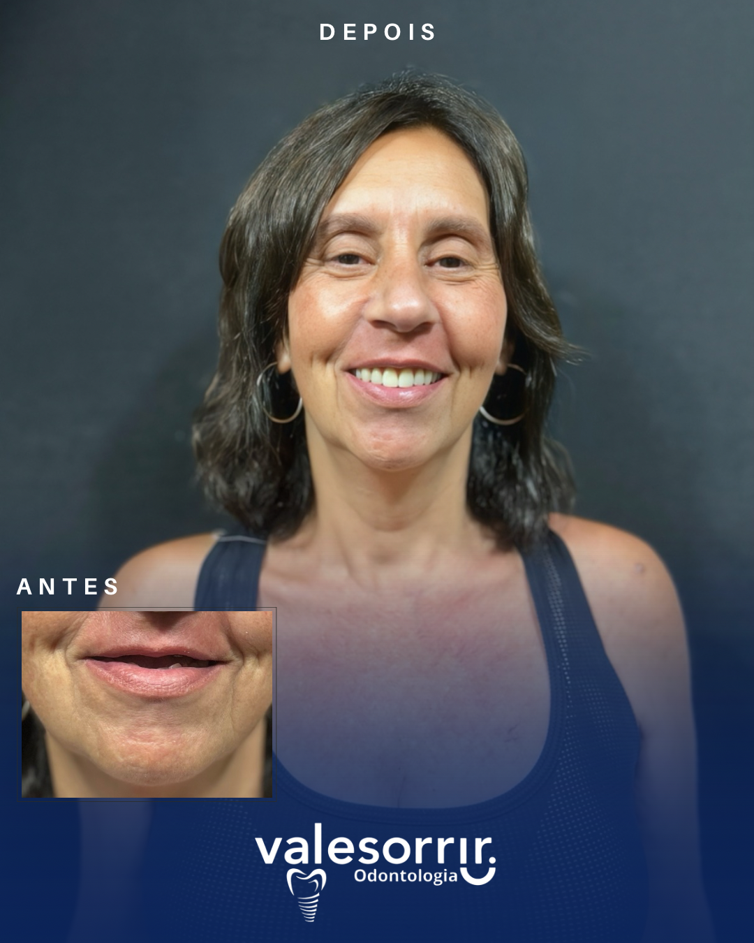 Cópia de Antes e depois - Edna